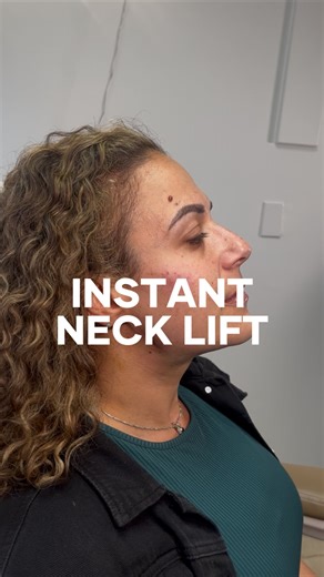 Cassandra RN on Instagram: "Skin laxity before and after PDO neck lift 🤩 BOOK NOW - Link in BIO⁠ 📱 Cranford: 908-460-6007⁠ 📱Morristown: 973-449-1415 📍 Based in Cranford and Morristown, NJ⁠ #jawlineeecontouring #jawlinefiller #jawlinegoals #jawlinefillers #jawlineslimming #liquidfacelift #nonsurgicalfacelift #facialcontouring #facialslimming #jawlinedefinition #facialbalancing"