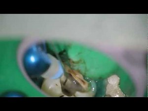 Endodontic Treatment with the use of Hand Files • Video • MEDtube.net