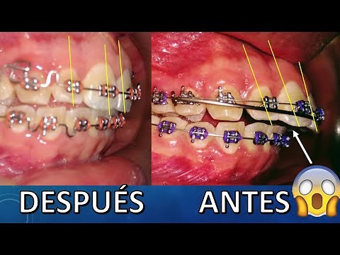 ¿Como mejorar dientes proinclinados, sin la extracción de dientes premolares en algunos casos?😎✌