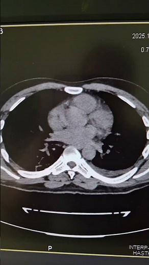 CECTAbdomen, Acute necrotising Pancreatitis.Modified CTSI score 10severe.B/L minimalpleural effusion