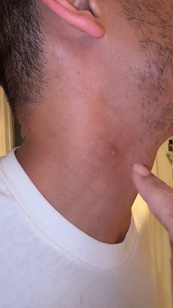 Day 3 Results with Prid Drawing Salve Progress