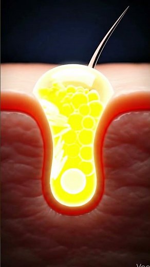 Why Some Pimples Hurt So Much Doctor Explained #skinhealth #dermatology #acne #skincare #healthyskin