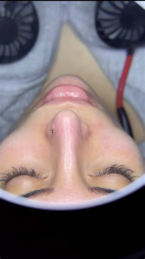 Nose Extractions: The Ultimate Satisfaction