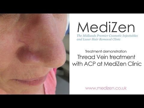 Treating Thread Veins with ACP at MediZen clinic, Birmingham UK