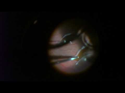 Retinal Detachment Repair | 25 gauge Vitrectomy with Gas