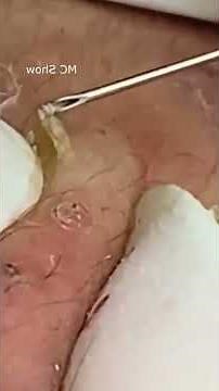 Pickel Ausdrücken Blackheads Mitesser Entfernung 🔴 61