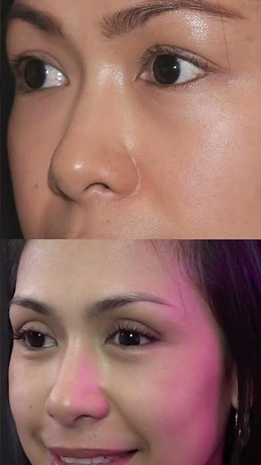 Blepharoplasty Before & After | Upper & Lower Eyelid Surgery Results | Dr. Bizrah/London/Dubai(1097)