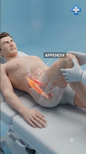 Is it Appendicitis? Understanding the Psoas Sign 🩺