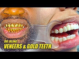 Veneers Procedure: Replacing Gold Teeth With Veneers / Adding More Gold Teeth