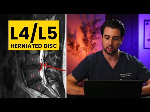 Lumbar MRI Breakdown of an L4/L5 Disc Herniation that Sent Her to the ER