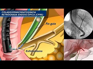🩺 O que é o exame CPRE? Saiba tudo sobre a Colangiopancreatografia Retrógrada Endoscópica!