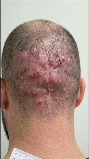 Successful Management of Dissecting Cellulitis of the Scalp: From Active Suppuration