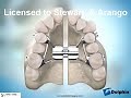 Surgically Assisted Rapid Palatal Expansion | Stewart Arango