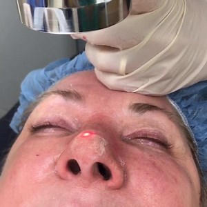 Erbium Laser Resurfacing for Rhinophyma