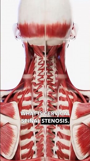 What is cervical spinal stenosis? #spinalstenosis #cervicaldischerniation #neckpainrelief #neckpain