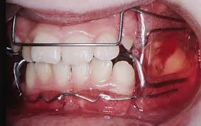 Aparato de Frankel: qué es y para qué se usa en ortodoncia