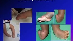 Clubfoot (Taleps Equino Varus): Etiology, Clinical Presentation, Incidence, Types and Management
