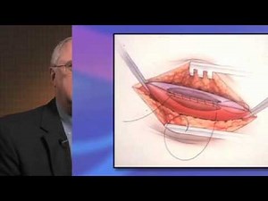 Importance of Fistula First Approach to Dialysis Access