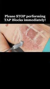TAP Blocks + Rectus Sheath Blocks = Complete Abdominal Wall Coverage. #nerveblock