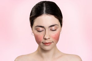 Couperose (rosacée) : quels sont les traitements efficaces ?