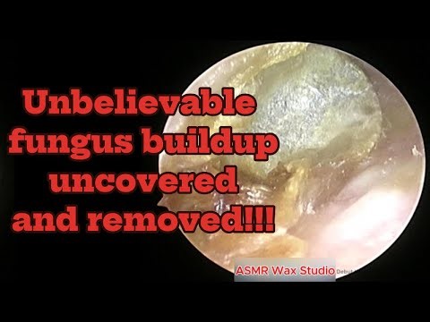 Unbelievable fungus buildup uncovered and removed | ASMR clean | relax | unwind |