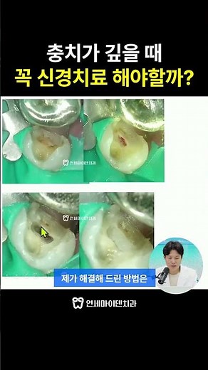 Deep Cavities: Is a Root Canal Always Necessary? | A Case Solved with VPT