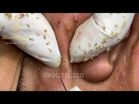 MEMORIES_remove BLACKHEADS 21 | Loan Nguyen