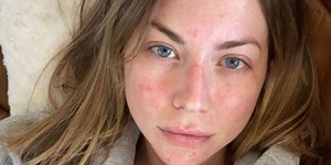 Stassi Schroeder Just Posted A Makeup-Free Photo Revealing Her Psoriasis