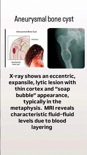 Aneurysmal bone cyst ! orthopedics | mbbs