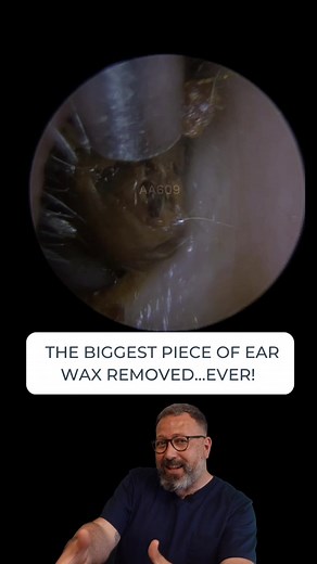 THE BIGGEST PIECE OF EAR WAX REMOVED....EVER! - PART 1 #ear #audiologyassociates #earwax #earwaxremoval #earcleaning