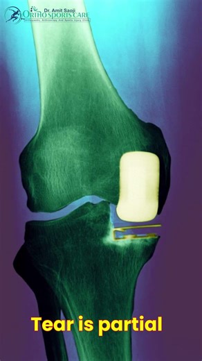 Can ACL Tear Heal Without Surgery? | Expert Ortho Advice by Dr. Amit Saoji, Nagpur