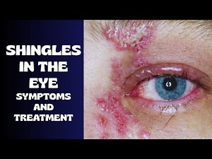 Why Shingles In The Eye (Ocular shingles) Should Be Treated Immediately