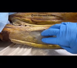 Jamie Decker | A fasciotomy surgery is a procedure known for cutting fascia to relieve pressure within muscular compartments due to a loss of blood... | Instagram