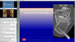 Open Fixation of Calcaneus Fractures