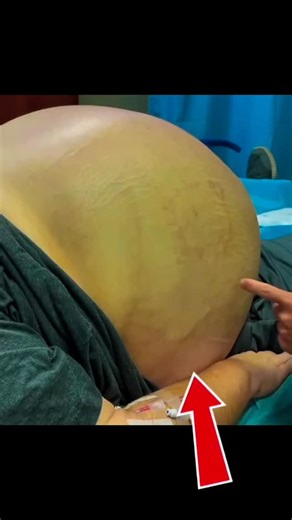 Dr Shailesh Gupta on Instagram: "Paracentesis, also known as ascitic tap or abdominal tapping, is a procedure that is mainly performed to drain the excess fluid from the abdominal cavity for diagnostic and therapeutic purposes."