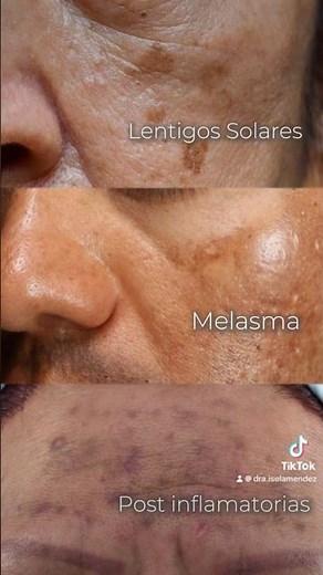 Clasificación de manchas ✨