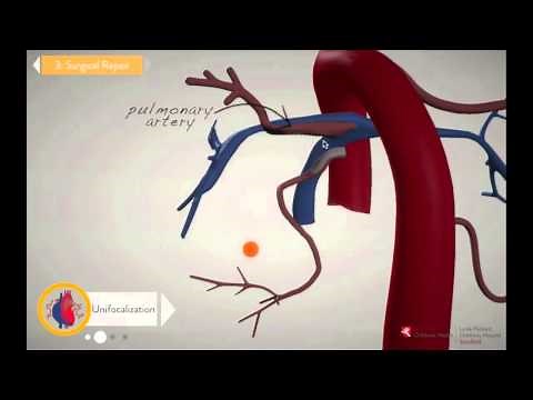 Chapter 3: Unifocalization & Repair - Stanford Children's Health