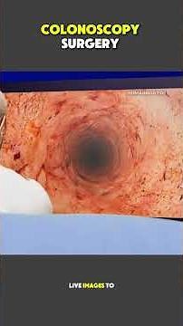 Colonoscopy Surgery Explained | What Happens During a Colonoscopy? #medicaleducation