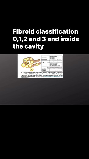 2.7K views · 41 reactions | Understanding fibroid location and impact | Fertility Courses | Facebook