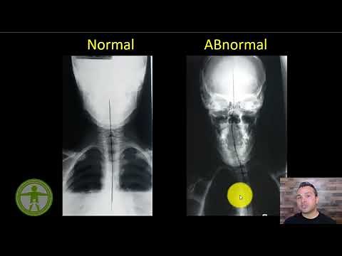 How to Understand Your Xrays - Normal Vs. Abnormal Spine Alignment