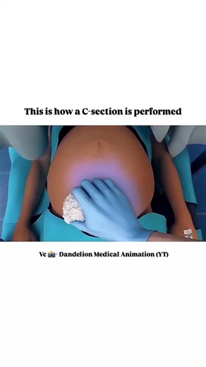 World of Biology on Instagram: "The process of C-section explained . . Amazing Animation by - @dmanimation (Thank you ❤️) . . Link to original video on Youtube channel 👇 https://youtu.be/pSJcxYg1QQ4?si=VugxpkIiHBNHLkYJ"