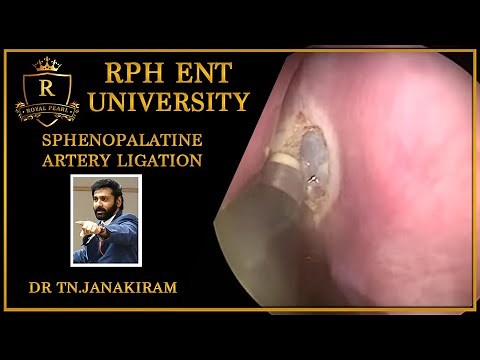 Sphenopalatine artery ligation