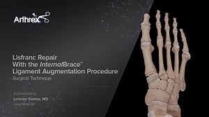 Lisfranc Repair With the InternalBrace™ Ligament Augmentation Procedure