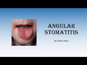 Angular stomatitis, redness and sores at edges of mouth - causes and treatment