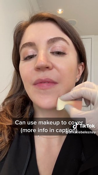 Bruising can occur with any injection (no matter who you are or how good your injector is). This bruise on me came from a filler injection. It can be covered with makeup and in this case my nurse is using the Colorescience Corrector Palette - one of our go-tos! We also give patients Dermablend makeup to go if they get bruising. Bruising will heal on its own but I wanted to show how a laser can also be used to speed up resolution. #drkatiebeleznay #fillers #bruise