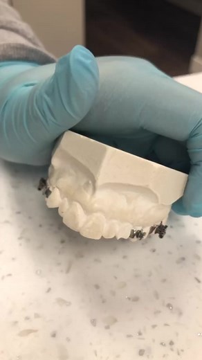 How to turn your expander! #magicvalleyortho #magicvalleyorthodontics #braces #orthodontics #twinfallsidaho #howto #foryou #fupage #teeth