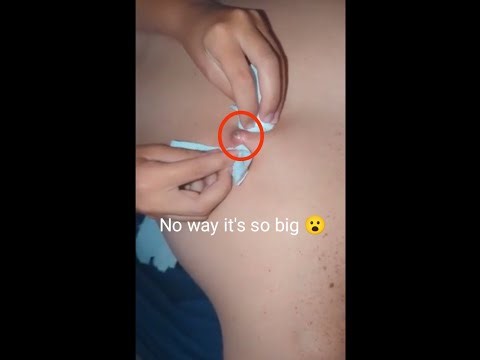 "Mind-Blowing Pimple Pop- Friend's Incredible Assistance Creates Unbelievable popping experience "