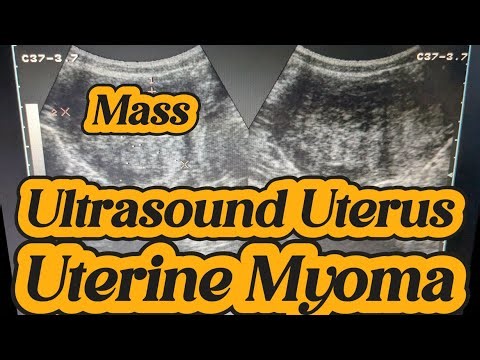 How to Ultrasound Uterus Fibroid | Ultrasound Uterus Mass | Uterine Myoma | Uterine Lesion