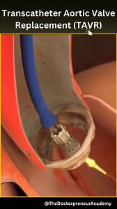TAVR: A Life-Changing Heart Procedure ❤️ Transcatheter Aortic Valve Replacement (TAVR) is a minimally invasive way to replace a narrowed aortic valve that doesn’t open fully. This condition, known as aortic valve stenosis, can slow blood flow from the heart to the rest of your body, causing symptoms like chest pain and shortness of breath. With smaller incisions than traditional open-heart surgery, TAVR can be a great option for those who aren't candidates for regular heart surgery. It’s all abo