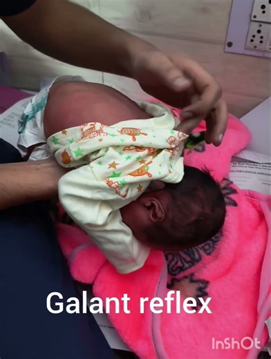 Galant reflex neonatal reflex #neonatalcare #neet #neetmotivation #neetpg #medical #medicalstudent